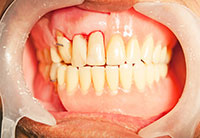 Dental Implants Aurora